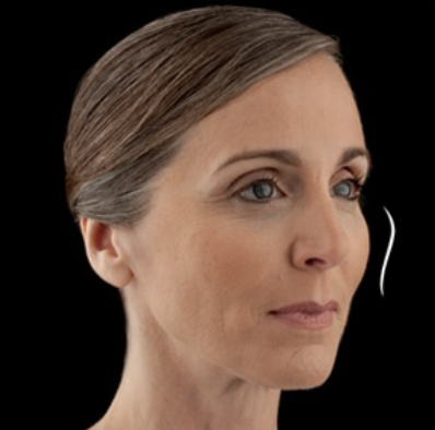 After cheek filler results NYC - restored facial volume and contours