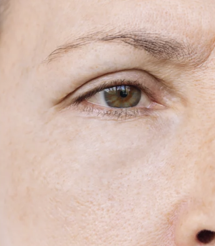 After Botox eye treatment NYC - smooth wrinkle-free results