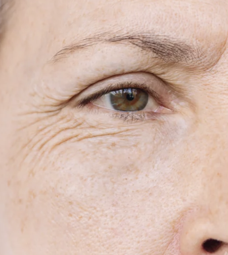 Before eye treatment Manhattan - crow's feet and fine lines